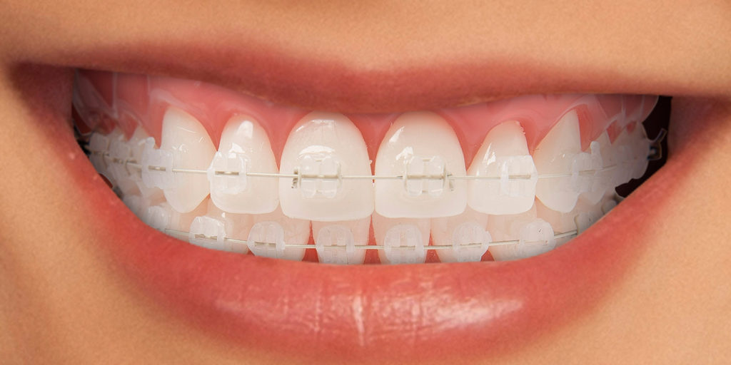 Qual è il costo di un apparecchio denti? Le varie tipologie - Centri  Dentistici Primo